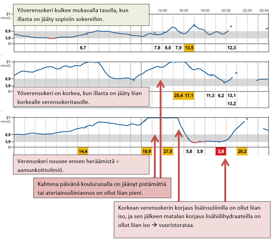 Esimerkkikuva sensorikäyrästä, jossa verensokeri vaihtelee kovasti, päivät ovat erilaisia.