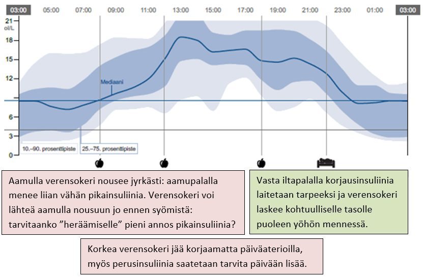 Esimerkkikuva sensorikäyrästä, jossa sama kuvio toistuu eri päivinä. Aamulla verensokeri nousee jyrkästi ja vasta iltapalalla korjausinsuliinia laitetaan tarpeeksi ja verensokeri laskee kohtuulliselle tasolle. 